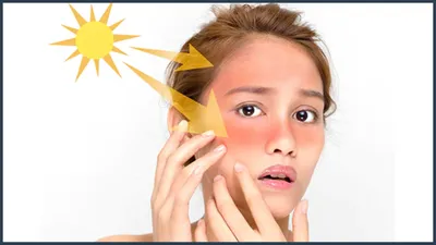धूप में स्किन काली क्यों हो जाती है  पहले एक्सपर्ट से जानें कारण और फिर सनबर्न का तेजी से इलाज कैसे करें 